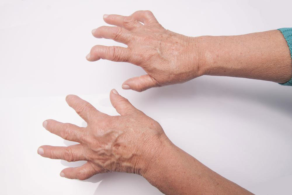 Symptoms, Causes, and Treatment or Rheumatoid Arthritis
