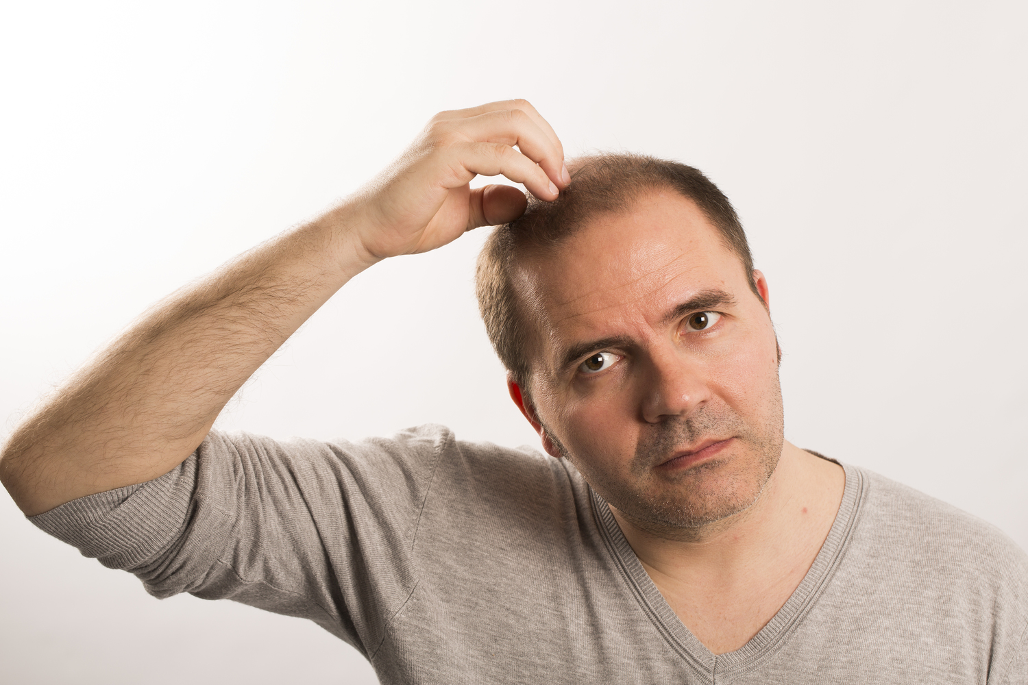 Ways to Manage Male Pattern Baldness